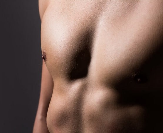 gynecomastia