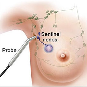 Lymph Node Surgery