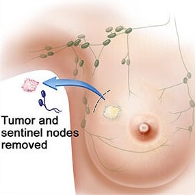 Lymph Node Surgery