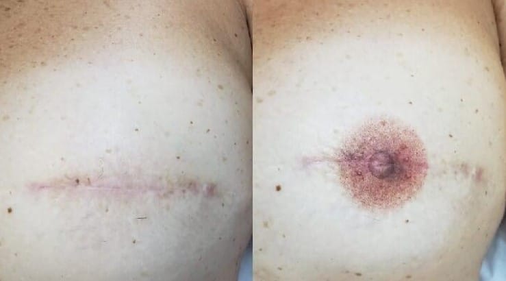 Breast Reconstruction following Mastectomy