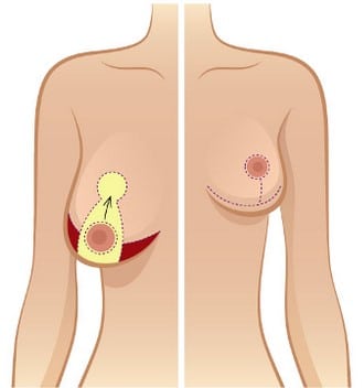 Breast Lift for Ptosis