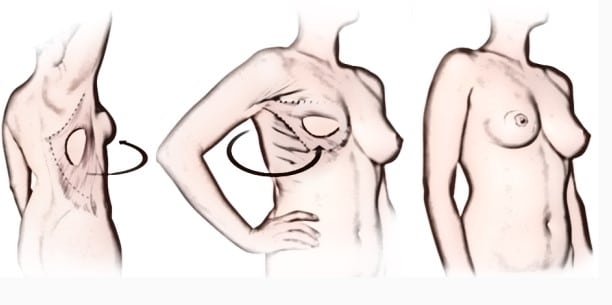 Breast Reconstruction following Mastectomy