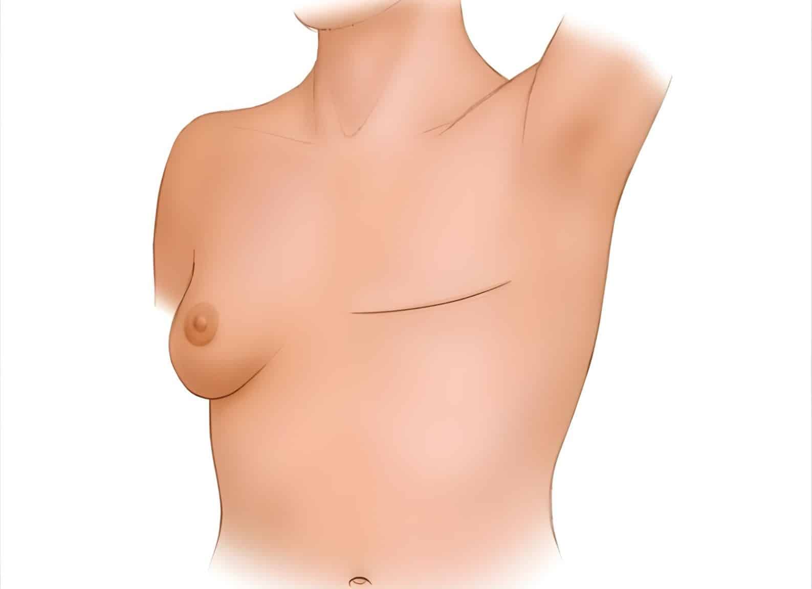 The Mastectomy