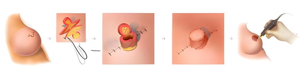 Areola and nipple Reconstruction