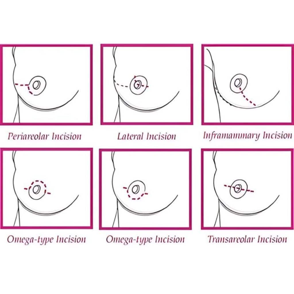 Prophylactic mastectomy