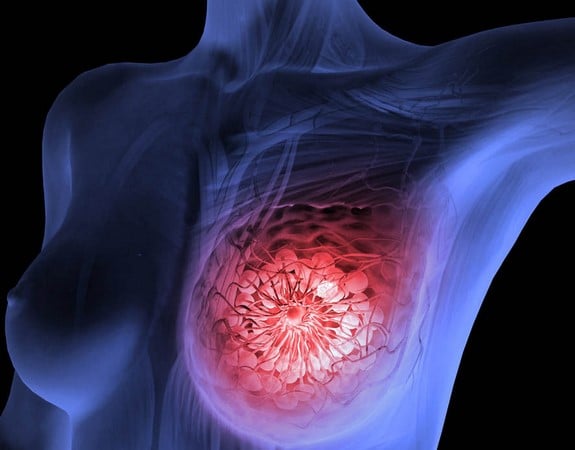 The Breast Conserving Surgery